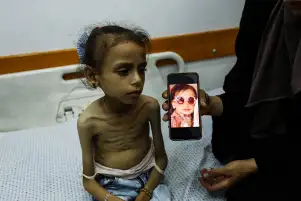 الجوع يقتل أطفال غزة: 63 وفاة بسوء التغذية في يوليو فقط